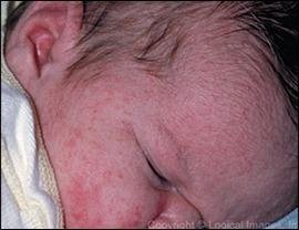 Common Newborn Skin Rashes 3-Erythema Toxicum