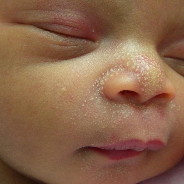 Common Newborn Skin Rashes 5-Milia