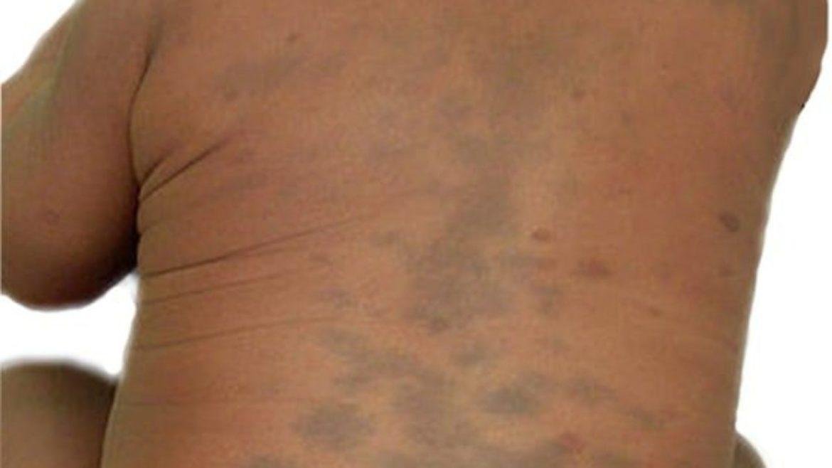Six Common Newborn Skin Rashes-Right Parenting