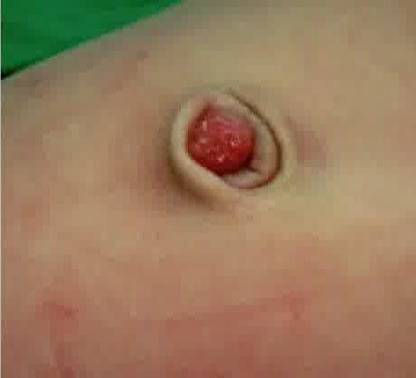 Common Newborn Skin Condition- Umbilical Granuloma