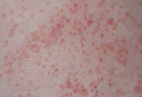 Common Newborn Skin Rashes  6- Miliaria