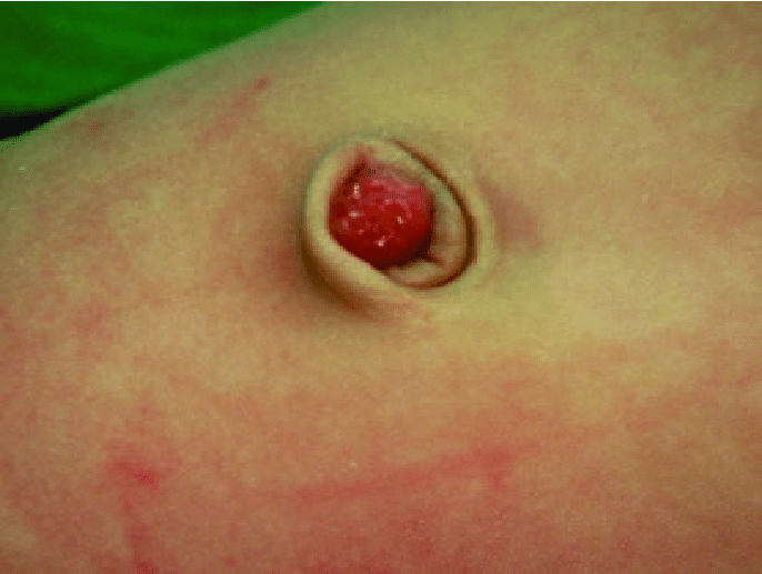 Umbilical Granuloma