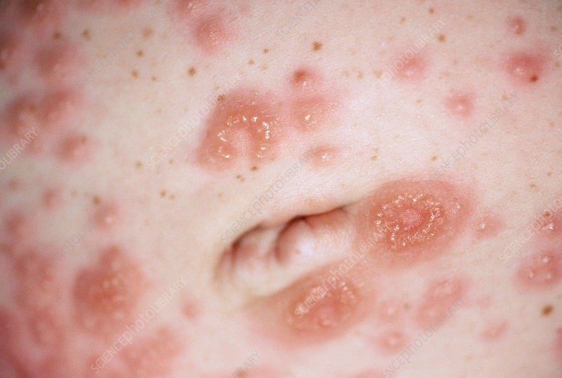 Pemphigoid Gestationis