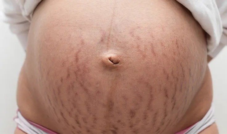 Pregnancy Stretch Marks