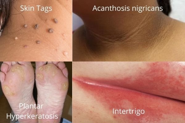 Common-Skin-problems-in-obesity