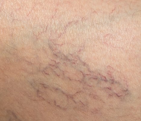 spider veins