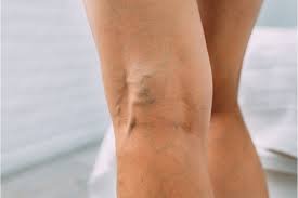 Varicose Veins