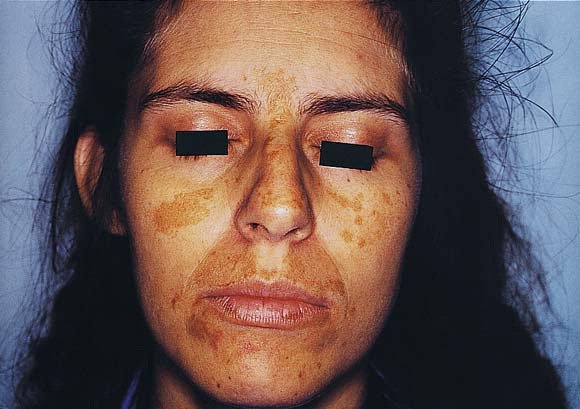Melasma-Mask of Pregnancy