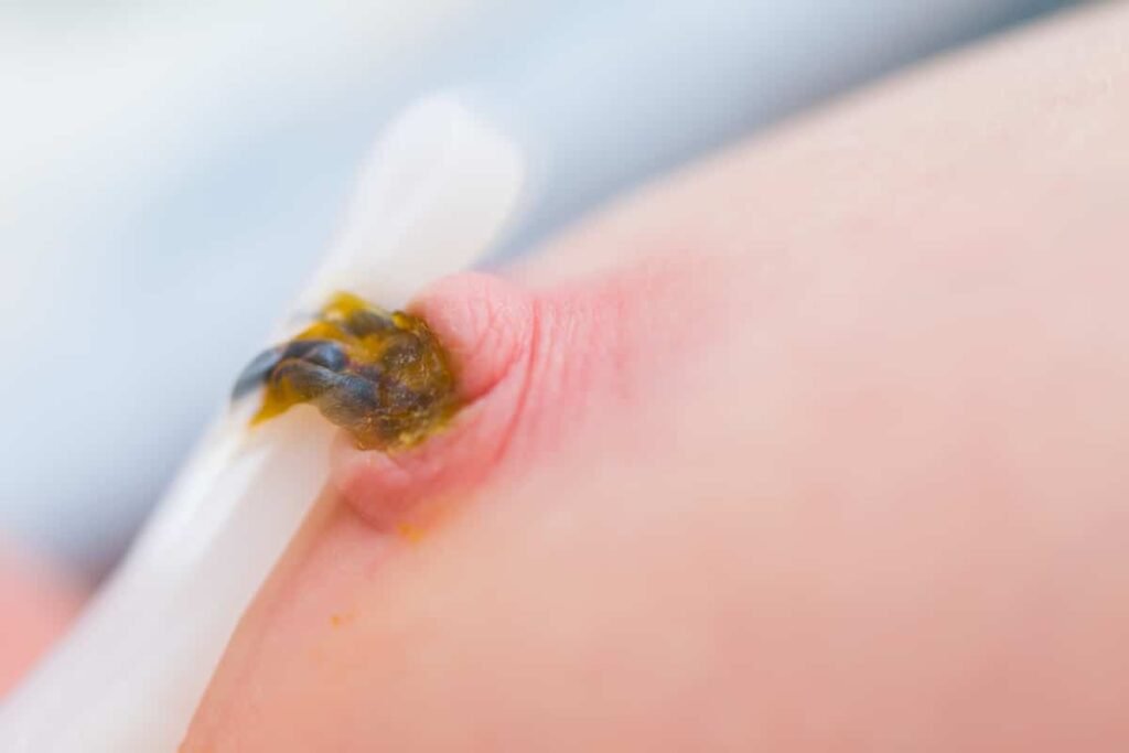 Umbilical cord infection Omphalitis